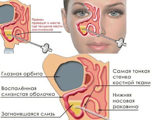 лечение гайморита